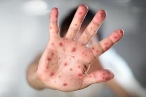На Закарпатье наблюдается острая нехватка вакцин от кори: заболевших уже 637