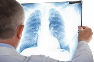 Украина попала в пятерку стран с самой высокой заболеваемостью туберкулезом